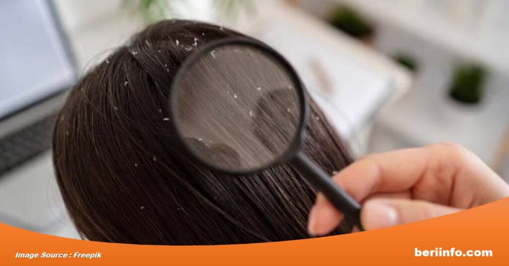 Cara Mengatasi Ketombe yang Efektif dan Terbukti Ampuh untuk Rambutmu yang Lebih Sehat